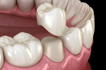 protesi dentarie brogliano vicenza